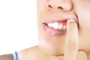 Why Your Gums Bleed When Brushing