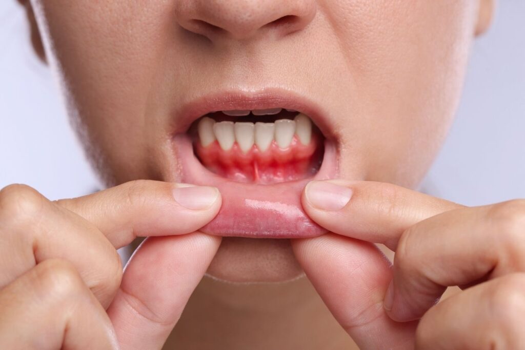 Gum Disease Treatment